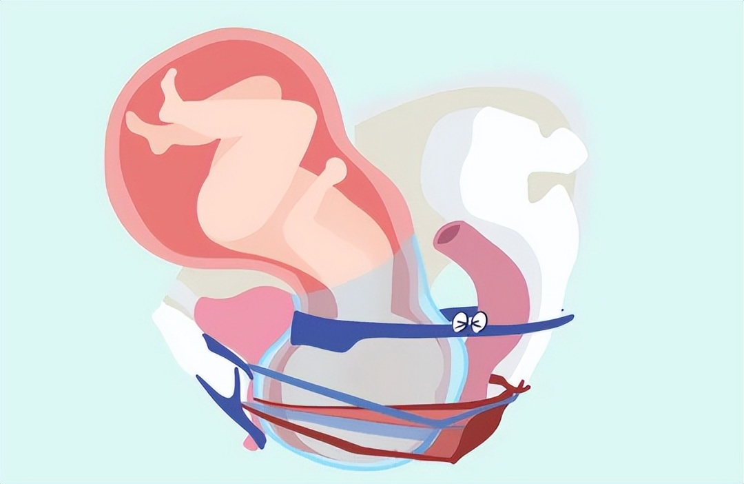 【一院·科普】盆底康复，可以“留”到二胎后一起做吗？