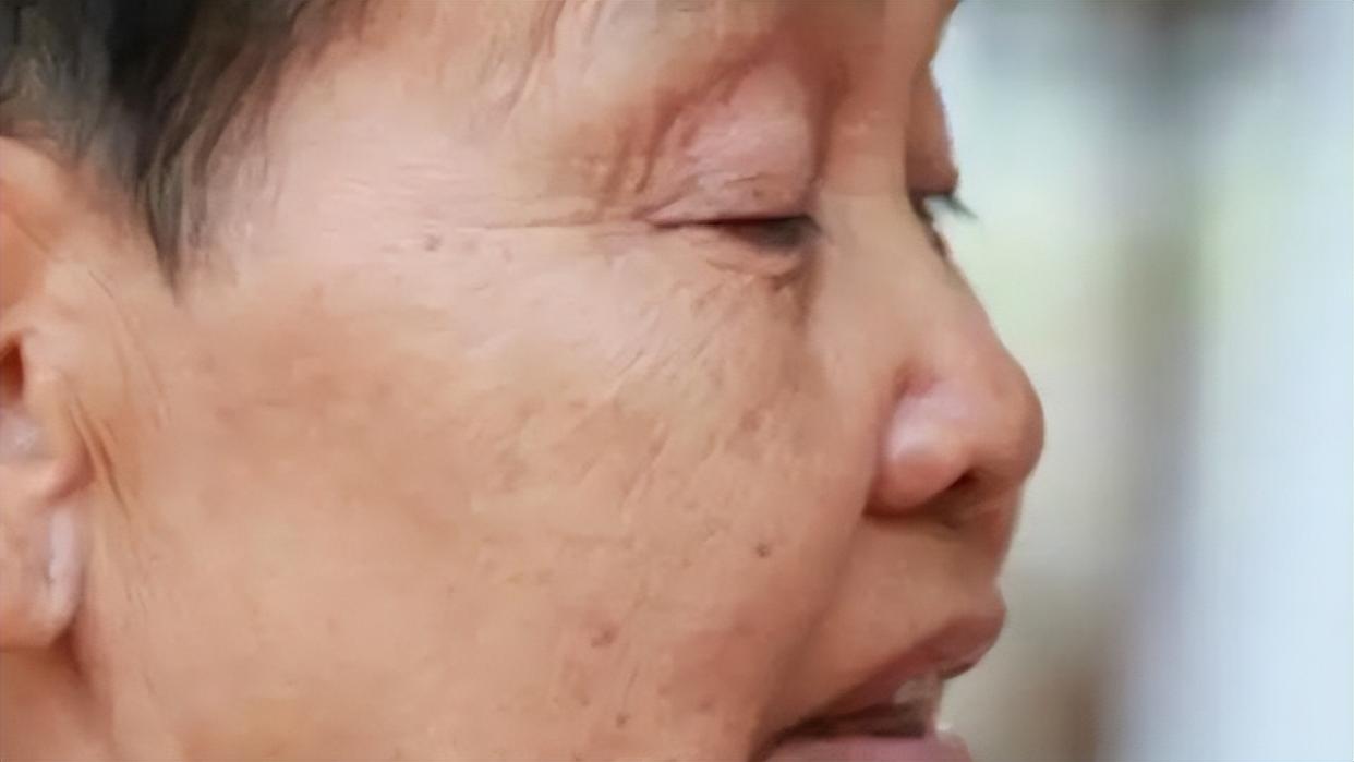 红霉素软膏能祛老人斑吗,老人身上长了老人斑为什么