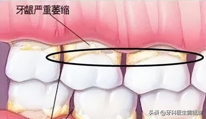 牙齿松动酸痛的原因是什么,牙齿咬起来酸痛是什么原因