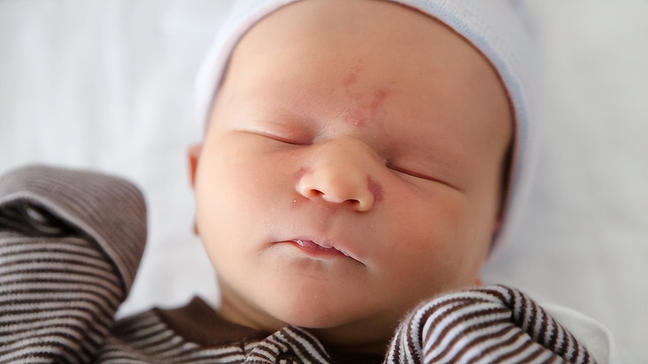 普萘洛尔可以用来治疗血管瘤吗,普萘洛尔治疗血管瘤的注意事项