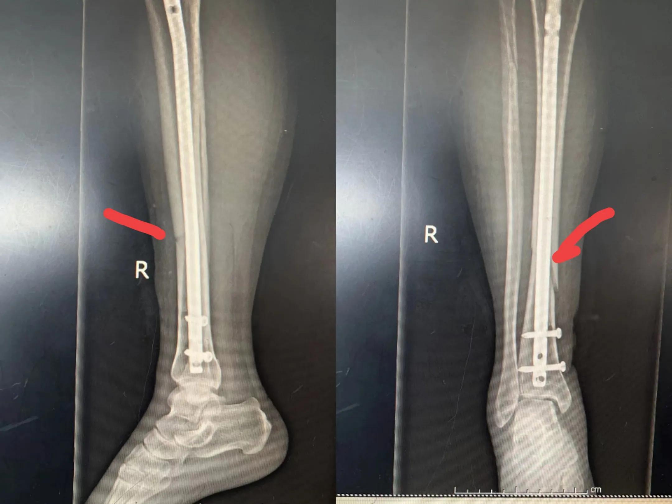 胫骨平台骨折科普,胫骨骨折疾病知识
