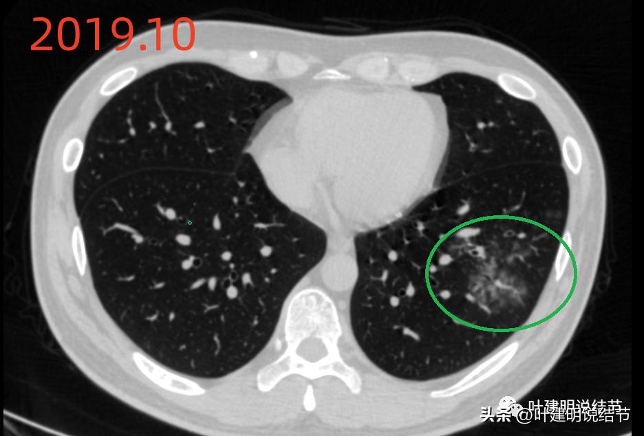 肺炎好了磨玻璃结节还存在,球形肺炎治愈后肺部留有结节