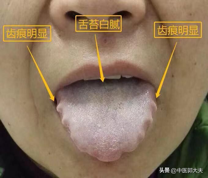 裂纹舌是舌头胖大后形成的吗,舌裂纹和地图舌是什么原因引起的