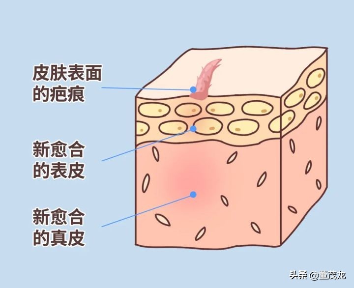 祛除疤痕增生最好的方法,易疤体质怎么祛疤