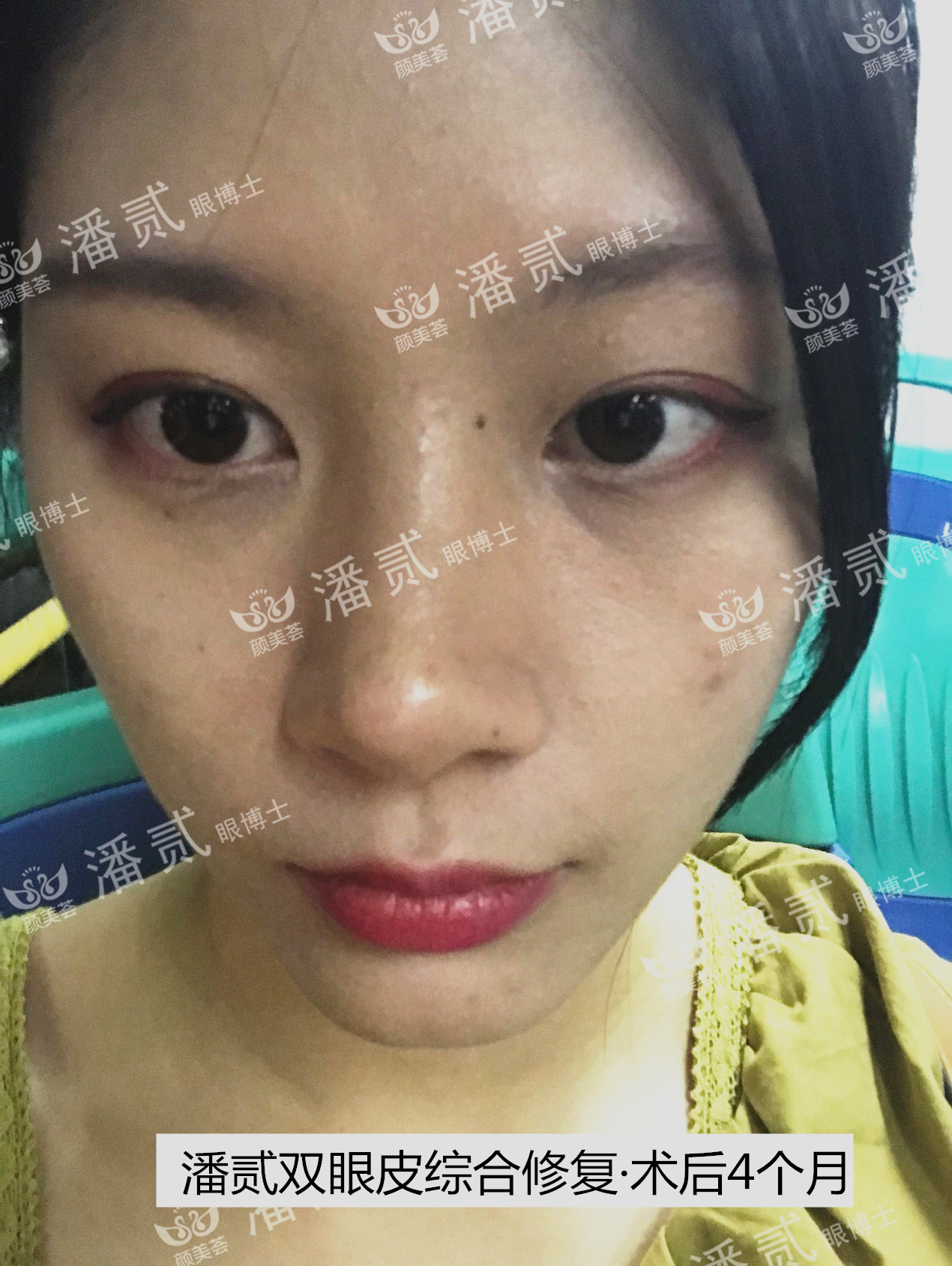 双眼皮贴导致眼皮破了,双眼皮贴导致眼皮严重下垂恢复