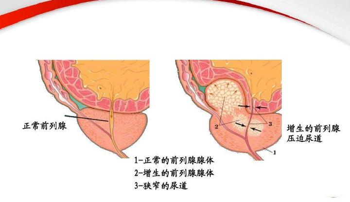 排尿费劲,滴滴答答怎么办?医生为您专业解答