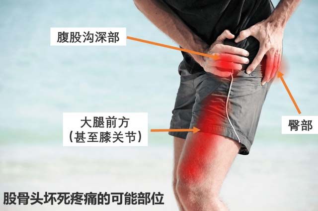 股骨头被误诊的几率,股骨头坏死有误诊的可能性吗