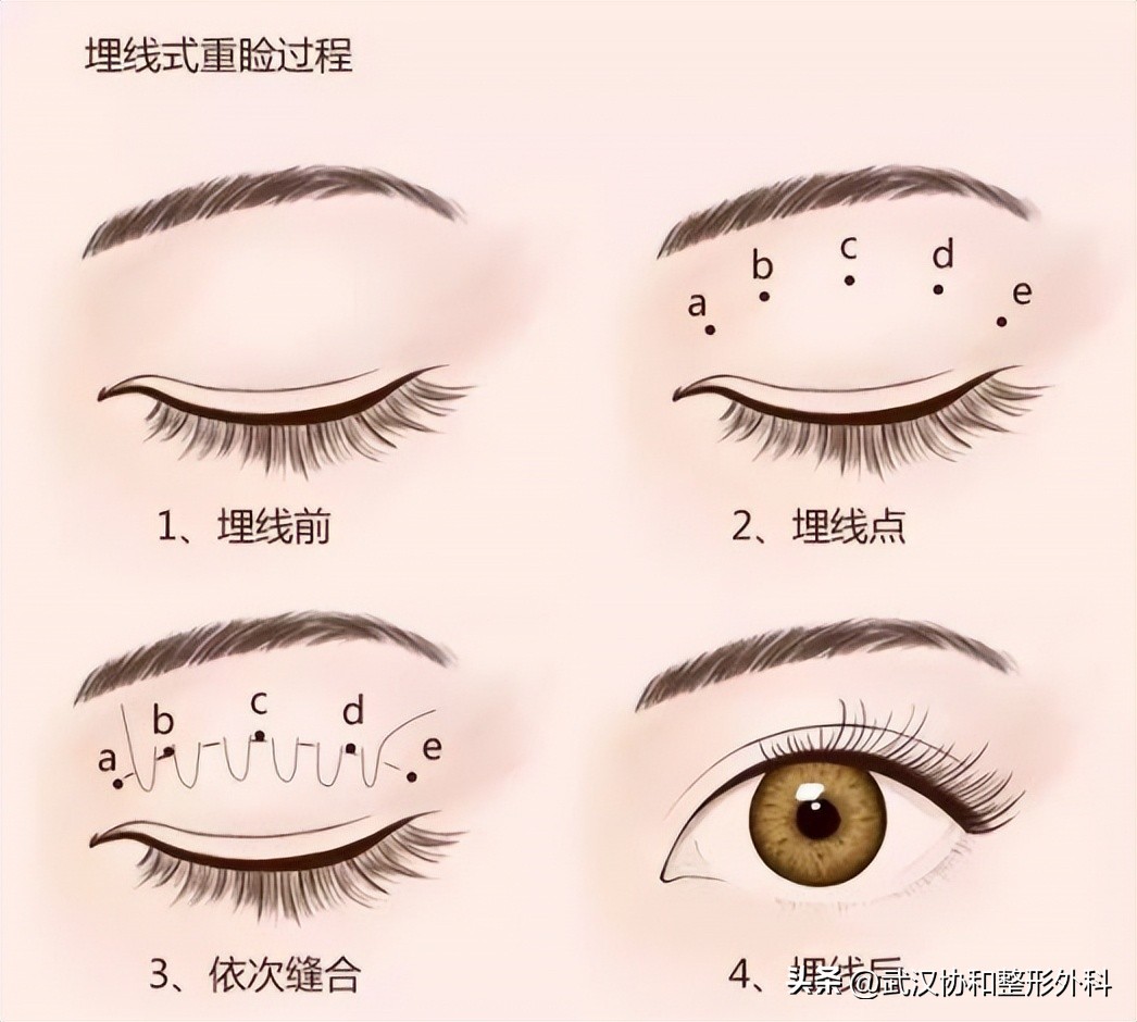 平行双眼皮手术图片,埋线双眼皮手术价格