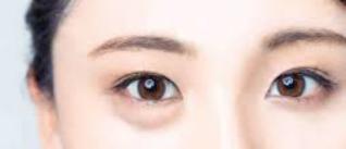 卧蚕眼袋大最简单的去眼袋的方法,消除眼袋方法多勿把卧蚕当眼袋