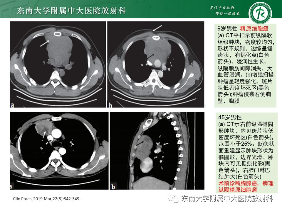 好文分享值得深思,纵隔精原细胞瘤