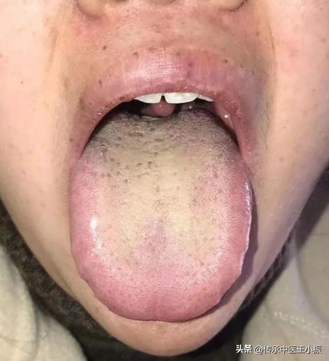 今日舌诊—实战分析—哺乳期女性，头晕口干、胸闷气短