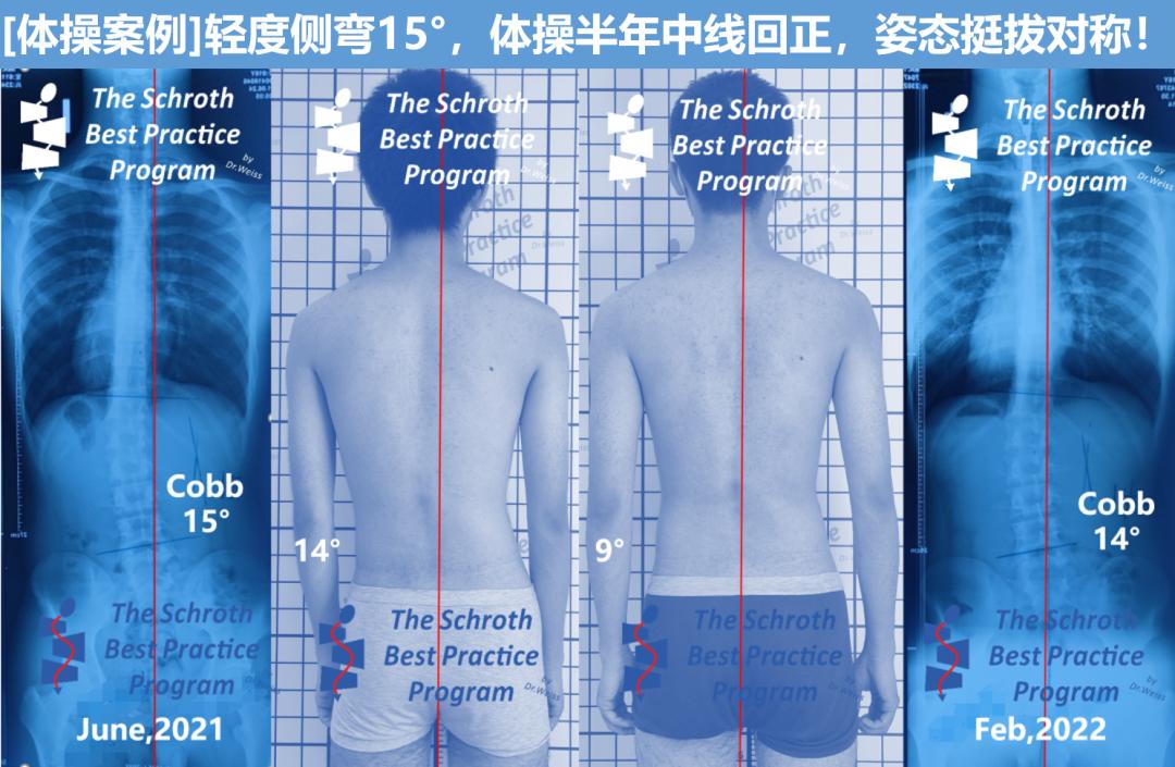 成人脊柱侧弯往哪弯,成年人脊柱侧弯怎么矫正