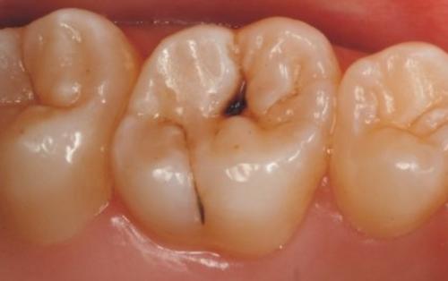 告别牙周炎的烦恼,告别牙痛