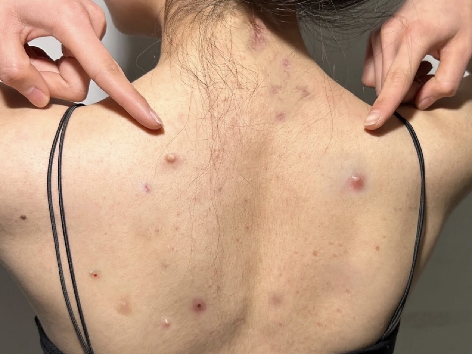 适合背后长痘的沐浴露推荐,祛后背痘痘的沐浴露前十名