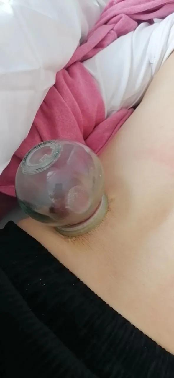 后背拔罐疼痛怎么缓解,拔罐能缓解后背疼痛吗