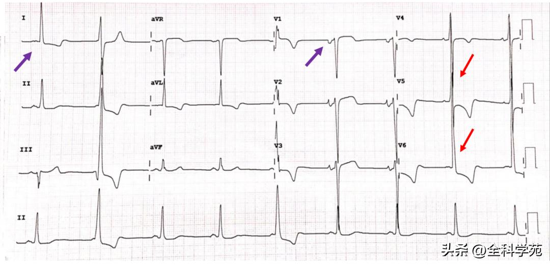 心电图笔记26：QRS波振幅变高，需要想到哪些
