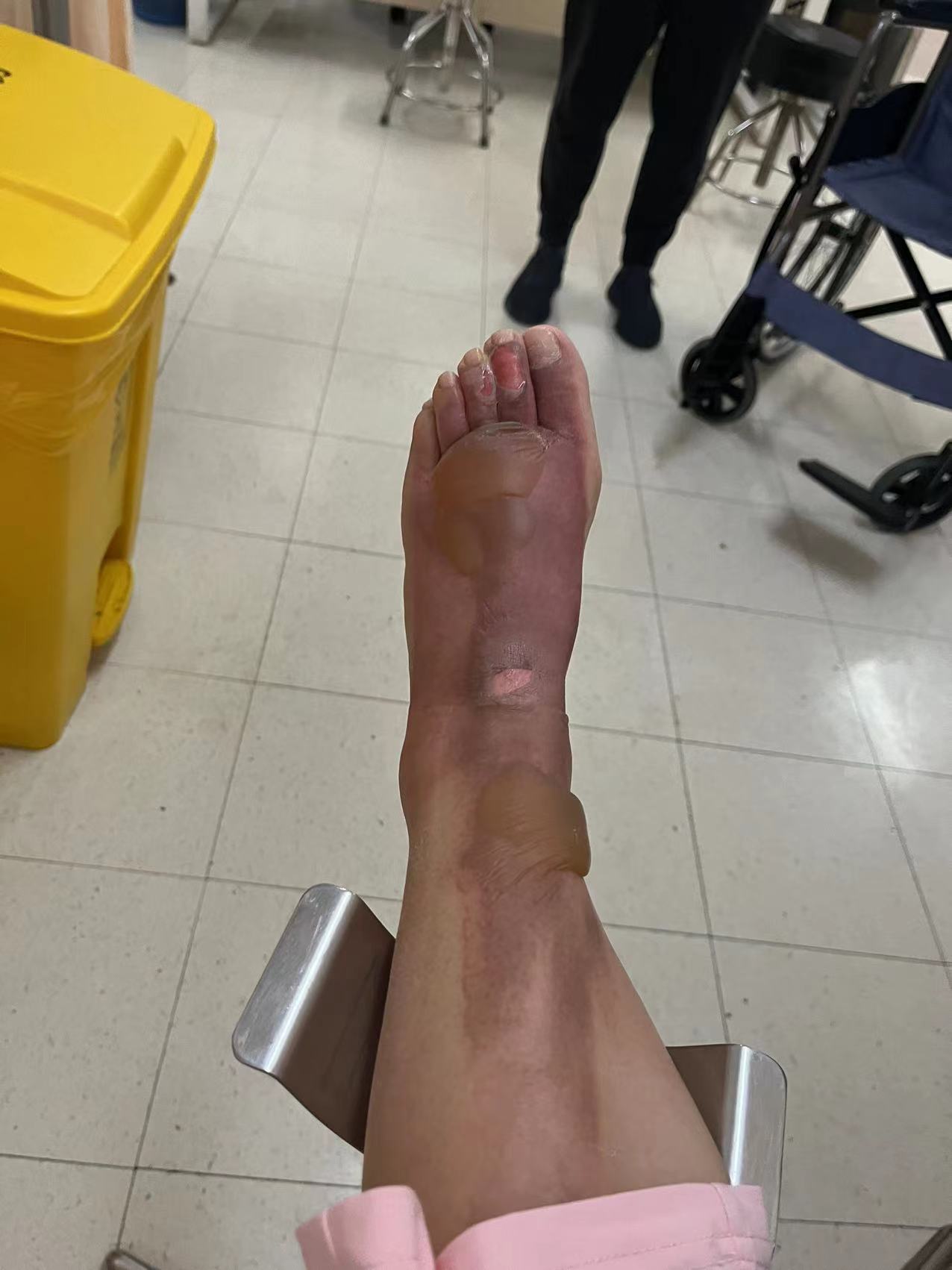 滚烫茶水泼身！双下肢4%二度烫伤！沪上月子会所内，二宝妈痛痛痛