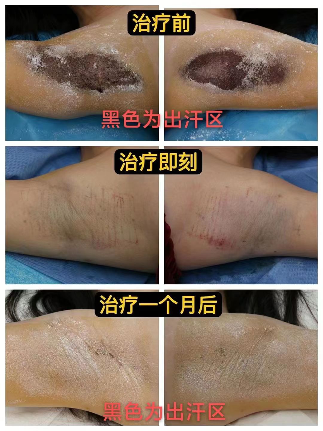 狐臭做过手术还有味道怎么办,狐臭用了乌洛托品怎么还有味道