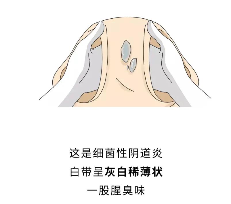 女生*处私**痒，居然是对“小蝌蚪”过敏？