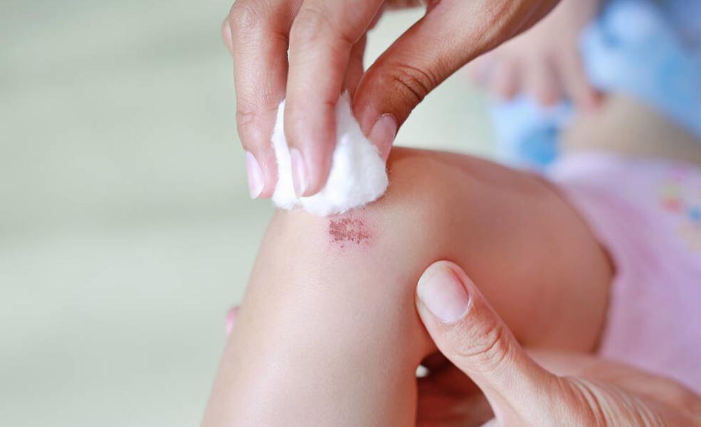 不注意小伤口得破伤风,伤口较小会不会得破伤风