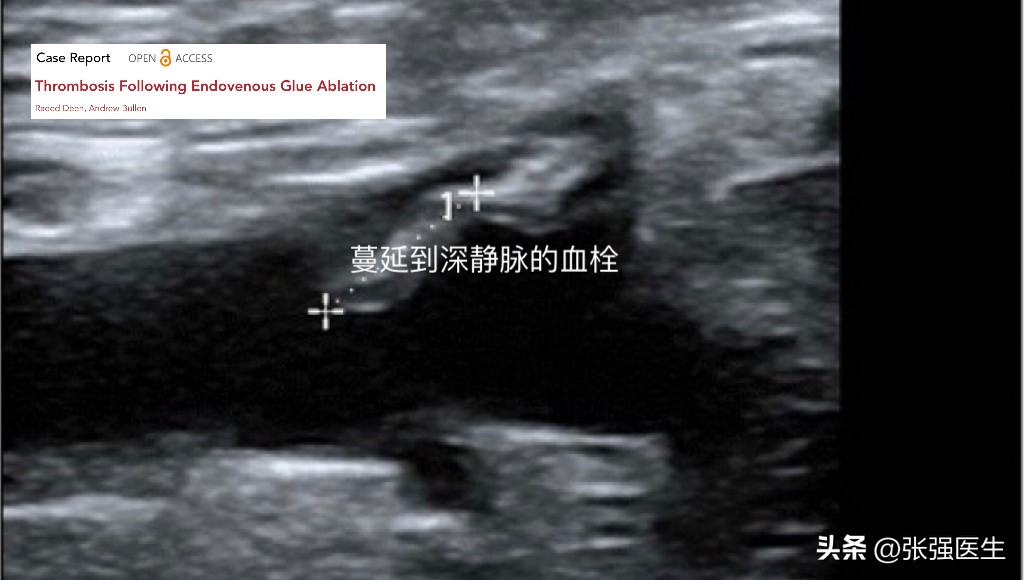 生物电疗可以治疗下肢静脉曲张,射频技术治疗下肢静脉曲张缺点