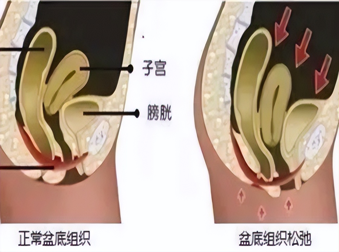 60岁女性盆底肌松弛漏尿如何治疗,老年盆底肌漏尿如何改善
