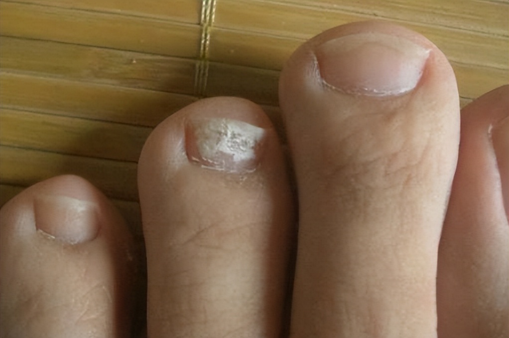 灰指甲接触的物品怎么处理,灰指甲周围皮肤都坏了如何处理