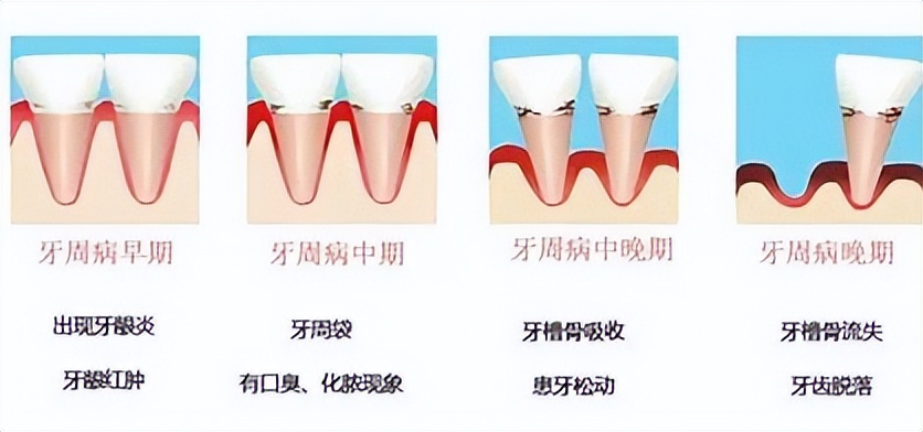 牙缝里的牙结石，如何清除干净？医生：2个办法是不少人的选择