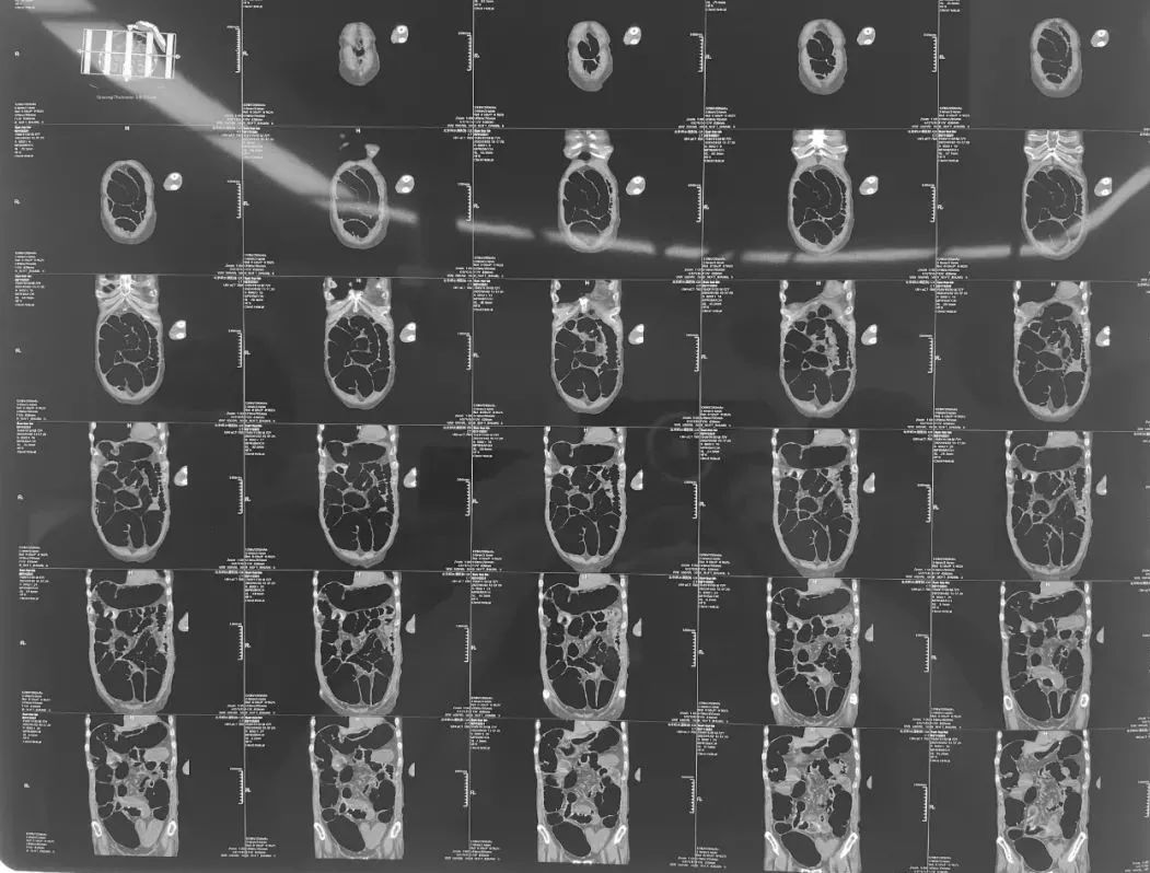 老人顽固性腹胀,老年因肿瘤引起的肠梗阻怎么办