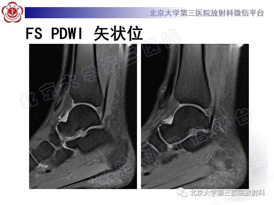 好文分享续集,腓骨肌腱脱位手术价格