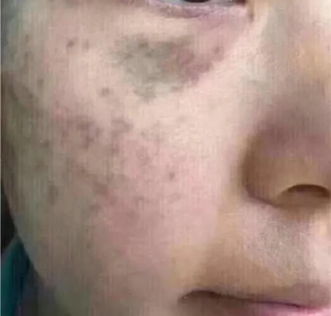 去脸上色斑,色斑怎么判断是哪种斑
