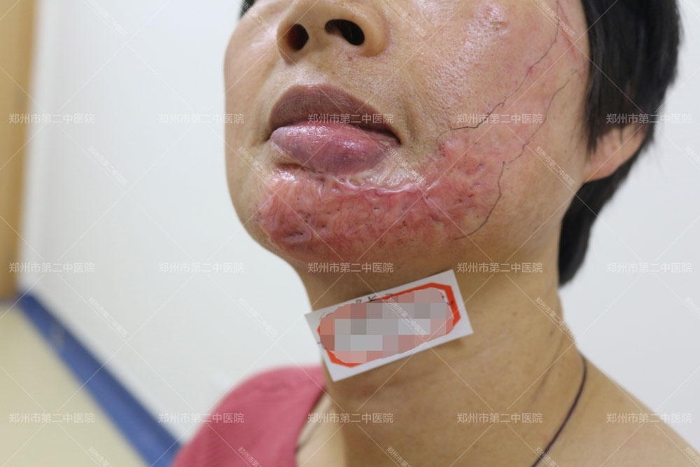 郑州脸部疤痕修复正规治疗医院,郑州第二中医院疤痕收费价格