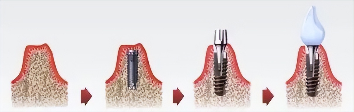 奥齿泰种植牙能用多久,种植牙多久可以抽烟