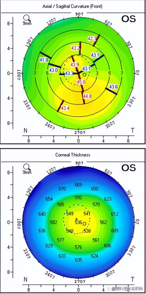 度数低角膜薄适合做哪种近视手术,角膜薄度数高能做近视手术吗