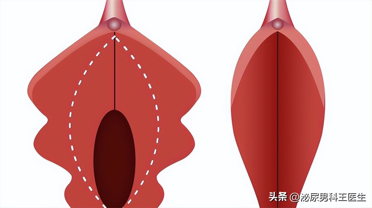 妇科检查显示宫颈肥大怎么办,外阴一侧突然肥大还能自愈吗