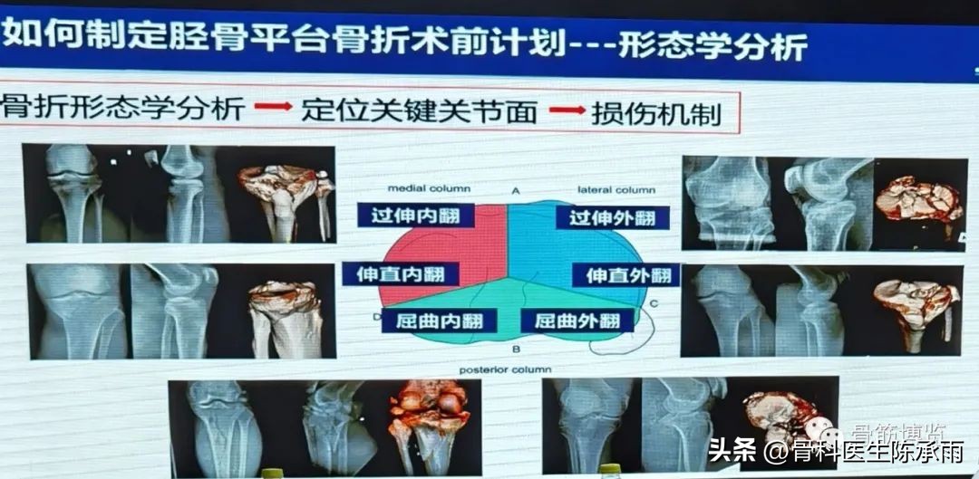 国家卫健委主办的骨创伤专项能力培训项目----下肢损伤学习班
