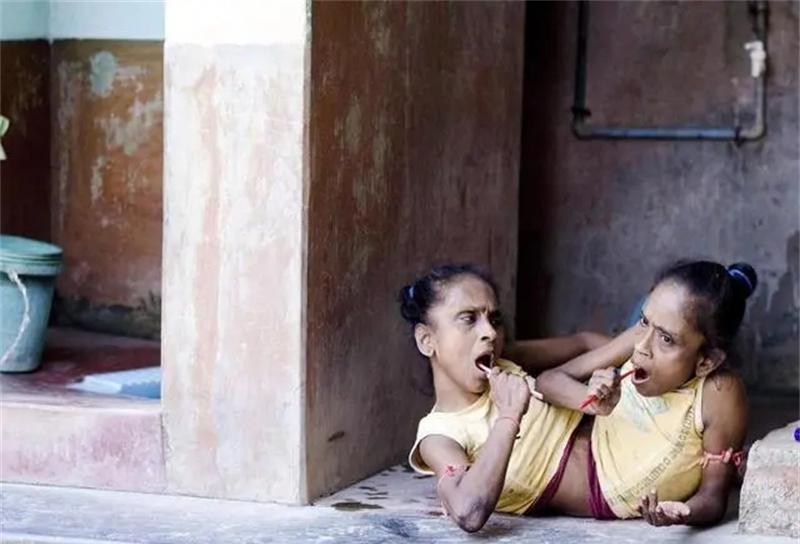 印度连体姐妹嫁给男子,印度男娶连体姐妹