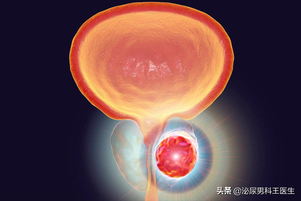 前列腺癌晚期骨转移症状有哪些,前列腺癌晚期患者临终前15个症状