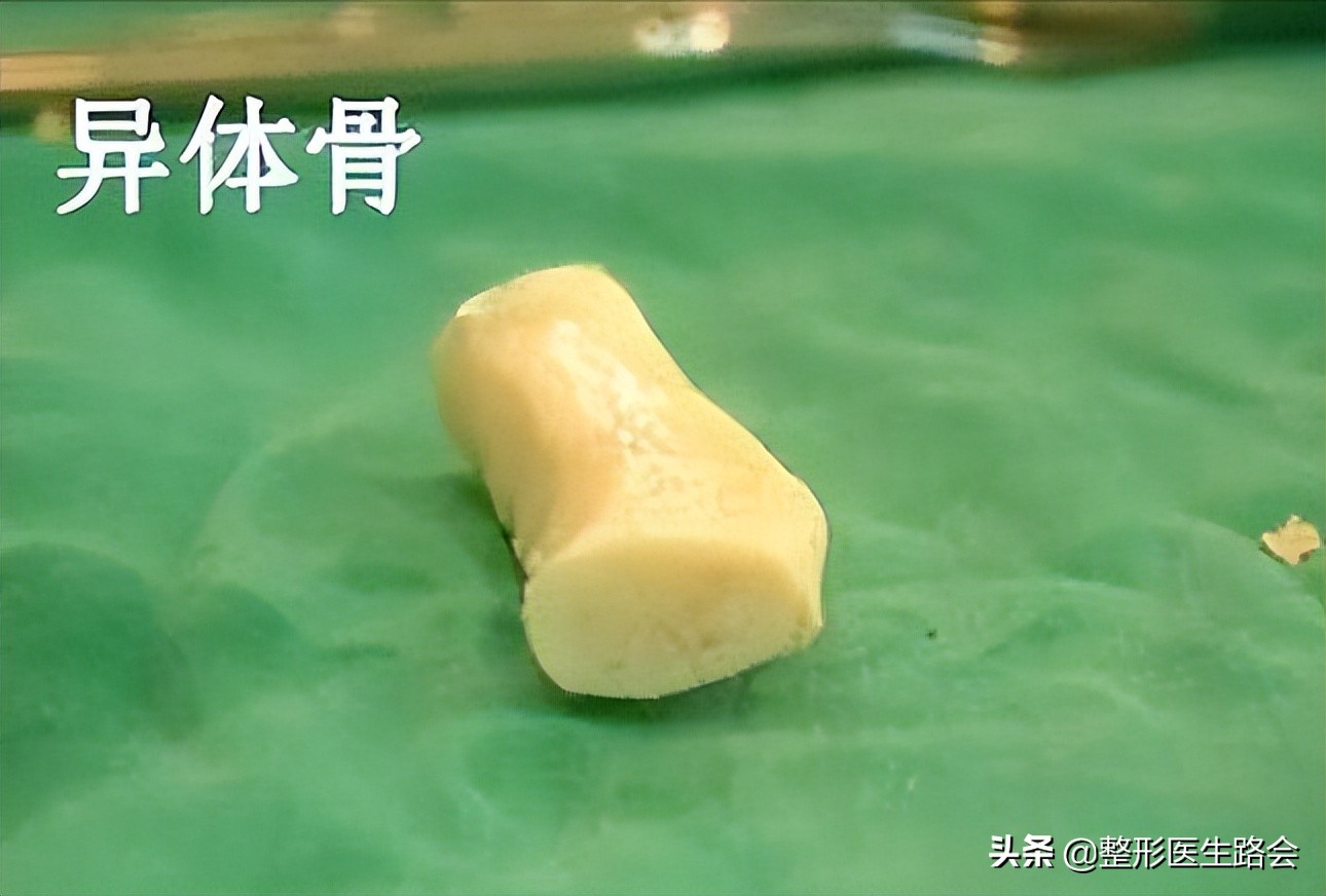 隆鼻失败鼻头有个坑的原因,隆鼻失败导致的鼻头凹陷怎么修复