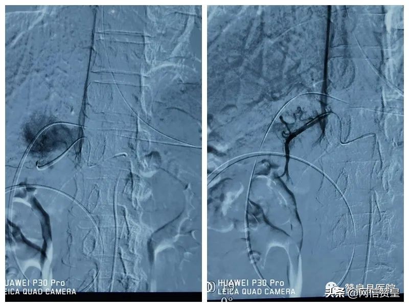 胃窦癌微创切除手术,胃窦癌根治切除术