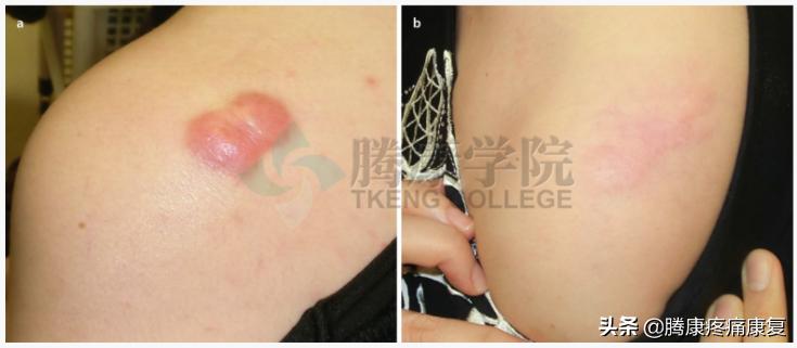皮质类固醇贴剂治疗瘢痕疙瘩,类固醇激素治疗疤痕增生