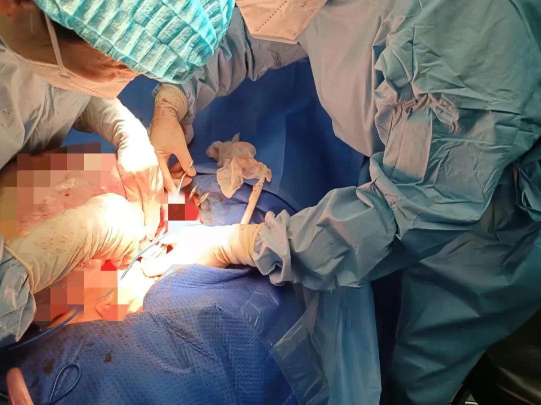 多科室协作完成妇科腹腔镜手术,医大一院妇科专家