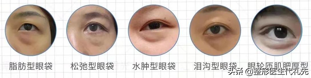 下眼袋下边的皱纹叫什么,下眼袋有皱纹图片