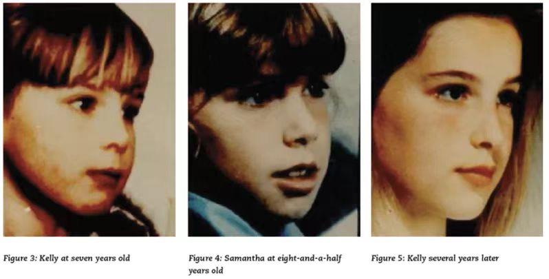 腺样体肥大造成嘴唇变厚会变丑吗,用嘴呼吸变丑还是腺样体肥大变丑