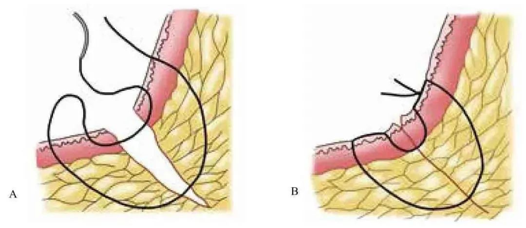 外科顶级缝针技术,外科缝合的操作细节你掌握多少