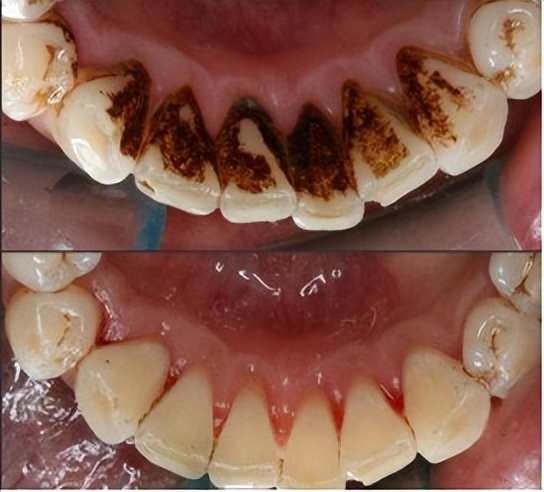 漱口水对口臭真的有用吗,一次性漱口水杀菌除口臭怎么用