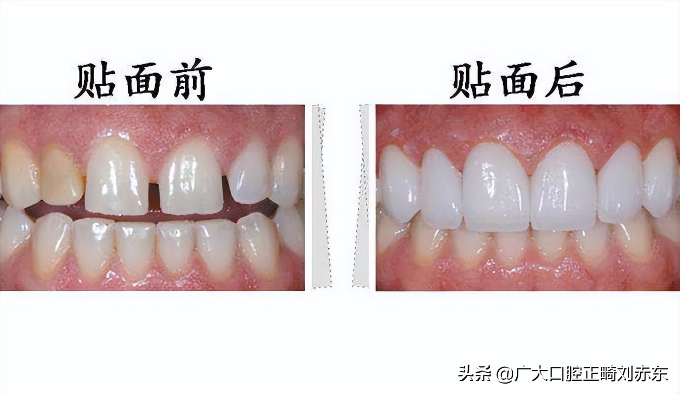 吃槟榔牙齿发黄怎么去除变白,牙齿抽烟发黄怎么去除变白