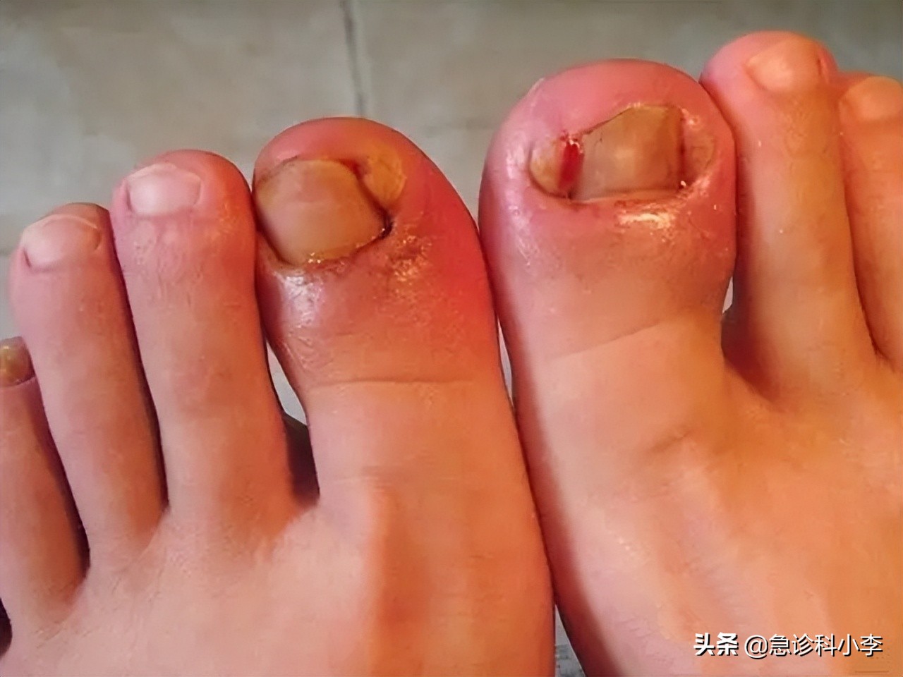 脚趾甲老往肉里钻,脚趾甲总是往肉里钻怎么办