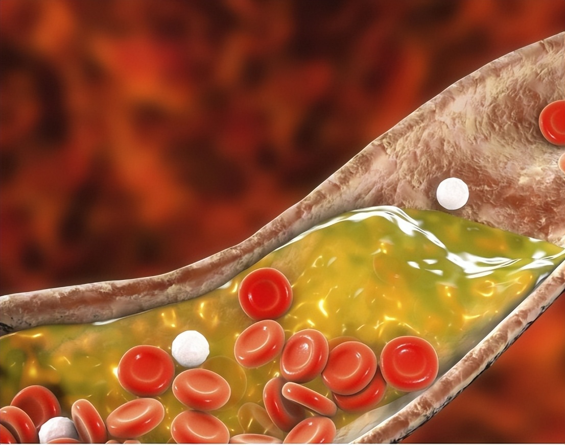 低密度脂蛋白高的2个解决办法,低密度脂蛋白偏高怎么才能降下来