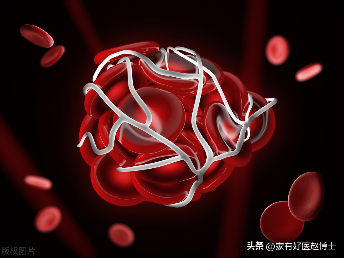 iwatch怎么预防心梗脑梗,张之瀛大夫如何预防心梗和脑梗